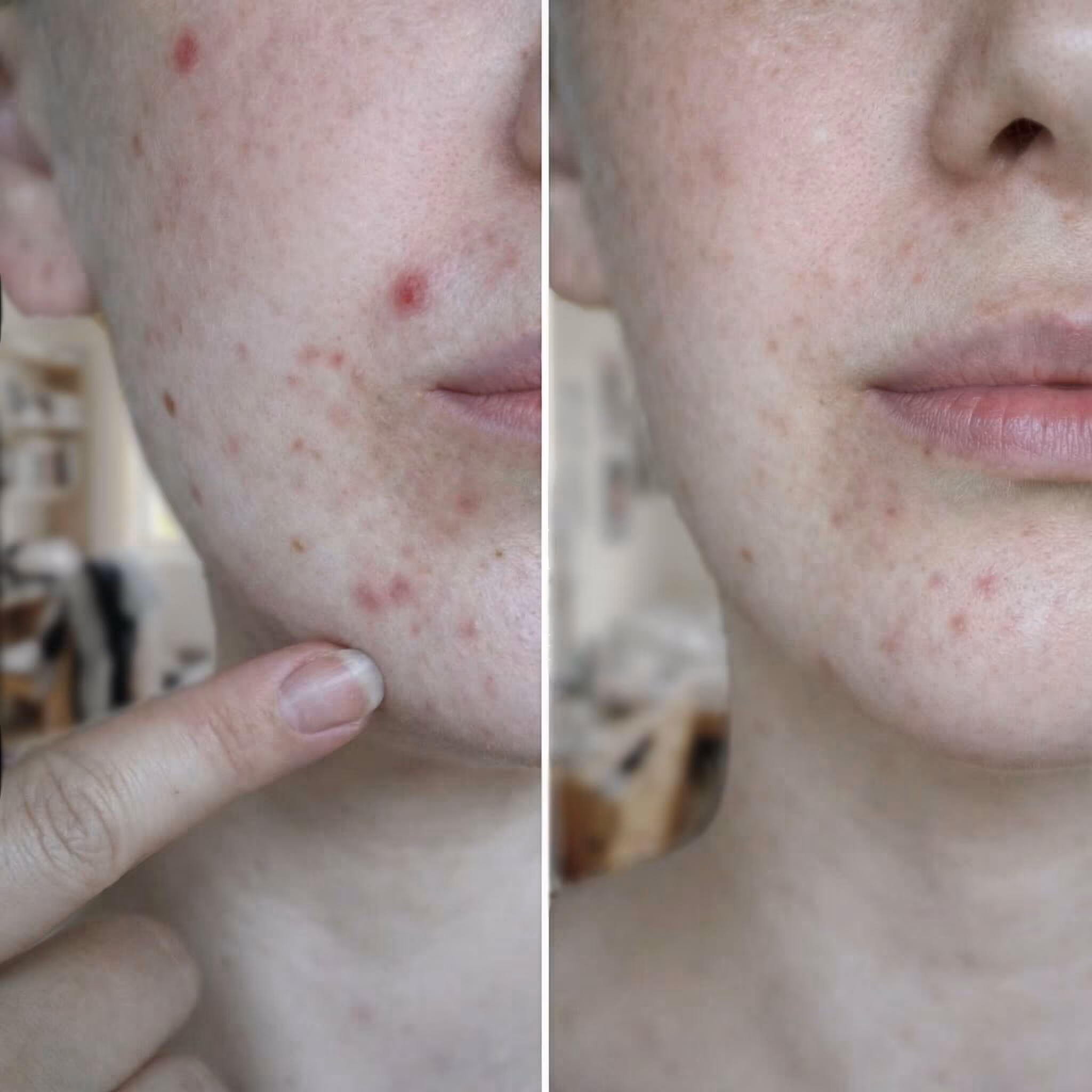 Skin Transformation - Acne